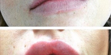 Lip Filler