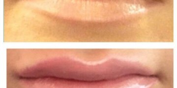 Lip Filler